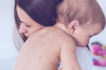 MMR vakcína: Osýpky, mumps, rubeola