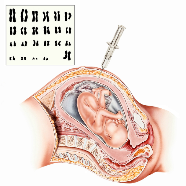 amniocenteza ako prebieha