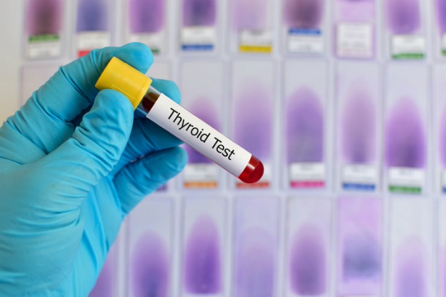 krvne testy stitna zlaza thyroid