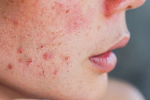 Dermatologička o akné: Samoliečba spôsobí viac škody ako úžitku