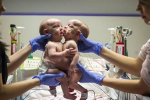 Lekári oddelili siamské dvojčatá. Fotografie sú neuveriteľné!