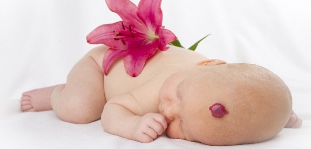 Hemangióm - červený fľak na telíčku novorodenca