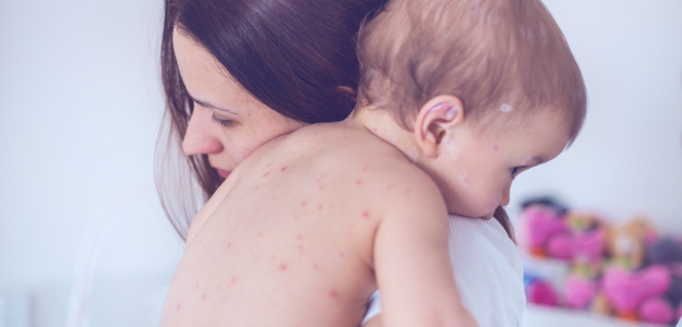 MMR vakcína: Osýpky, mumps, rubeola