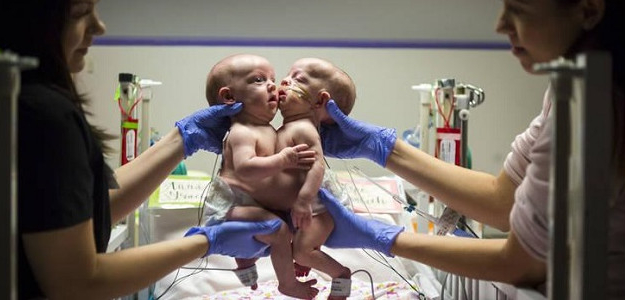 Lekári oddelili siamské dvojčatá. Fotografie sú neuveriteľné!