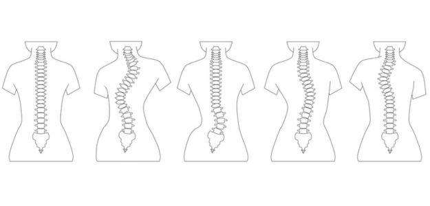 Skolióza: Účinnú rehabilitačnú metódu vynašli Česi, populárna je aj u nás